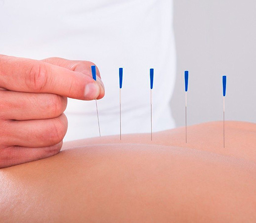 Иглорефлексотерапия